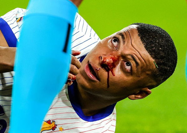 Kylian Mbappe nose injury