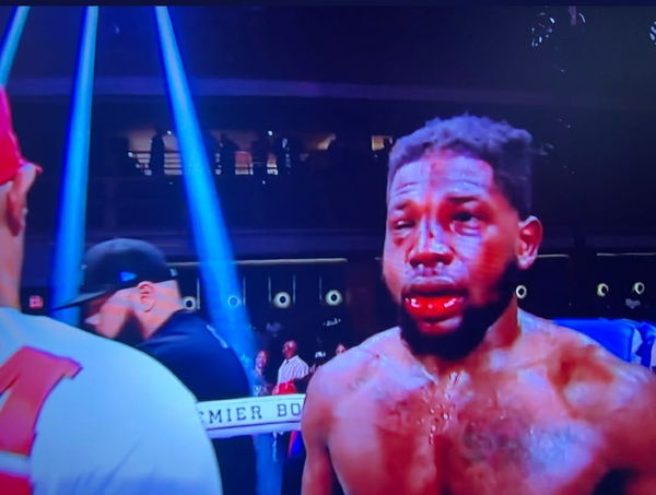 Graphic Warning: Boxer Erickson Lubin's Face Gets Ripped to Shreds in His  Second Career Defeat - EssentiallySports