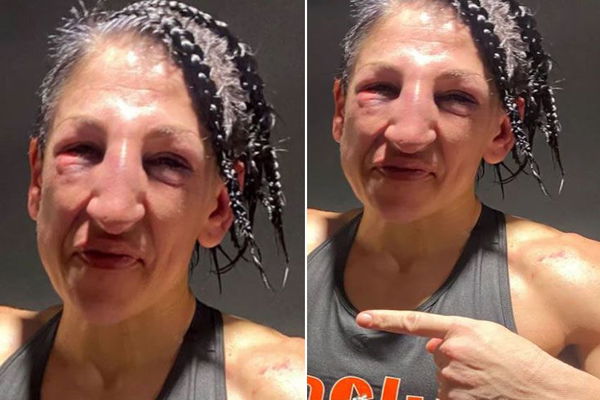 World Champion Boxer Regrets Disfiguring Her Opponent's Face- “I